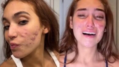 Como funciona o tratamento para acnes como as de Vanessa Lopes